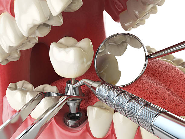 Best Emergency Wisdom Teeth Removal in Lake Sherwood, CA